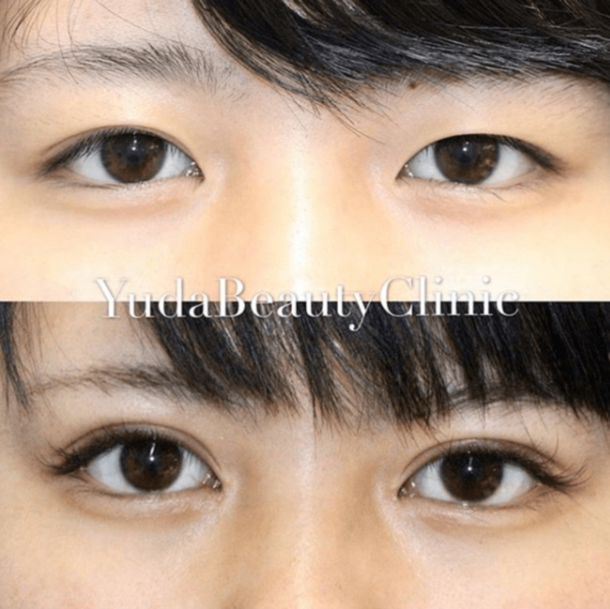 湯田眼科美容クリニック　目頭切開　症例