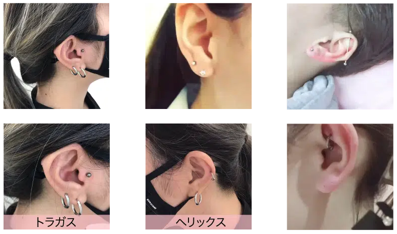 渋谷美容外科クリニックのピアス穴開け症例写真