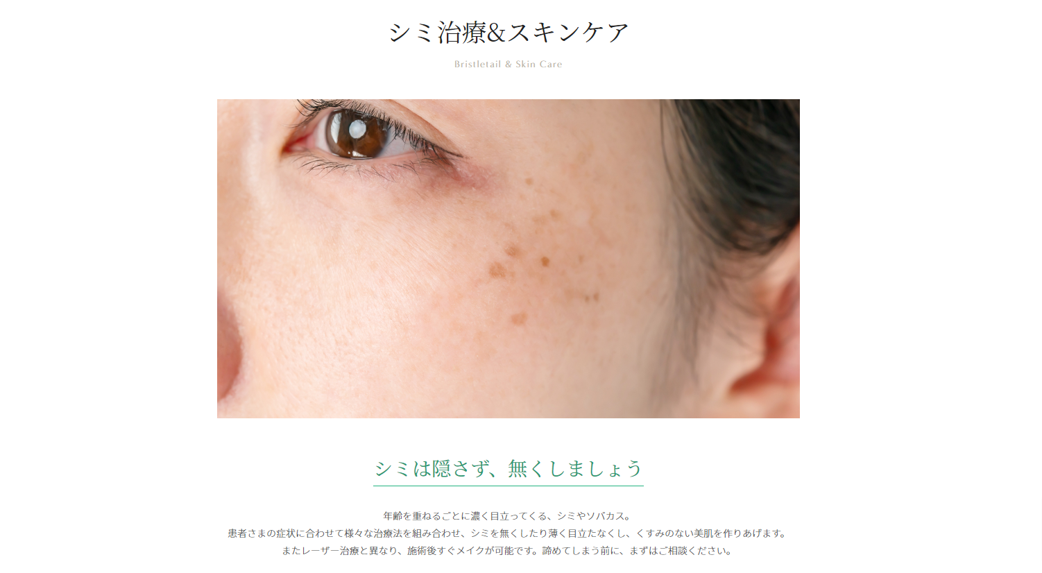 シミ・そばかす・肝斑の治療｜美容皮膚科エルムクリニック