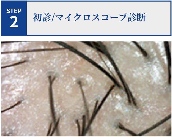 STEP②：初診/マイクロスコープ診断
