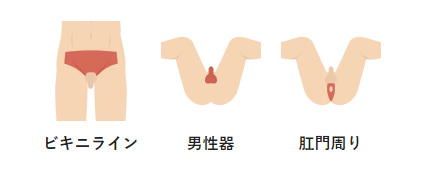 VIO脱毛の範囲