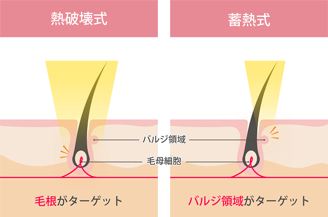レーザーの種類