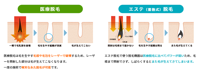 永久脱毛の効果