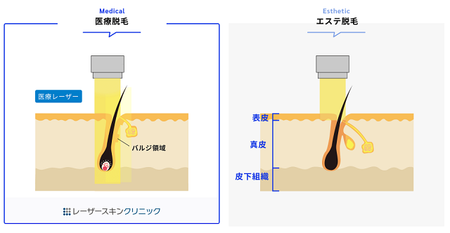 本格的な医療脱毛