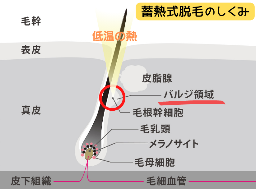 蓄熱式脱毛のしくみ