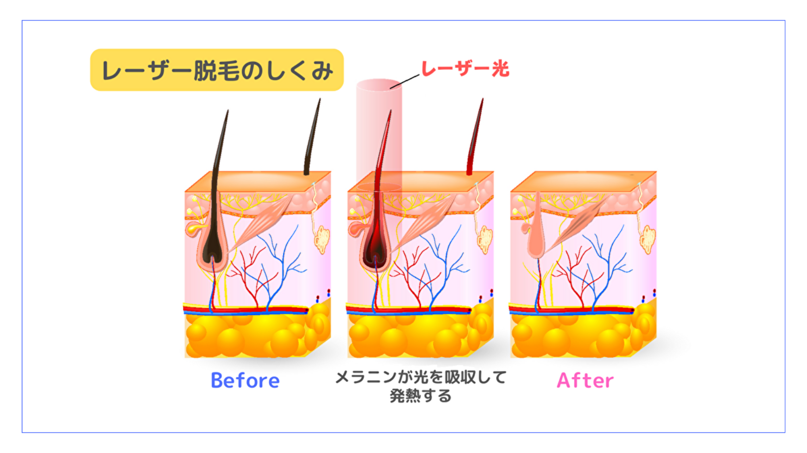 レーザー脱毛のしくみ