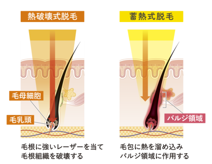 熱破壊式脱毛と蓄熱式脱毛の違い