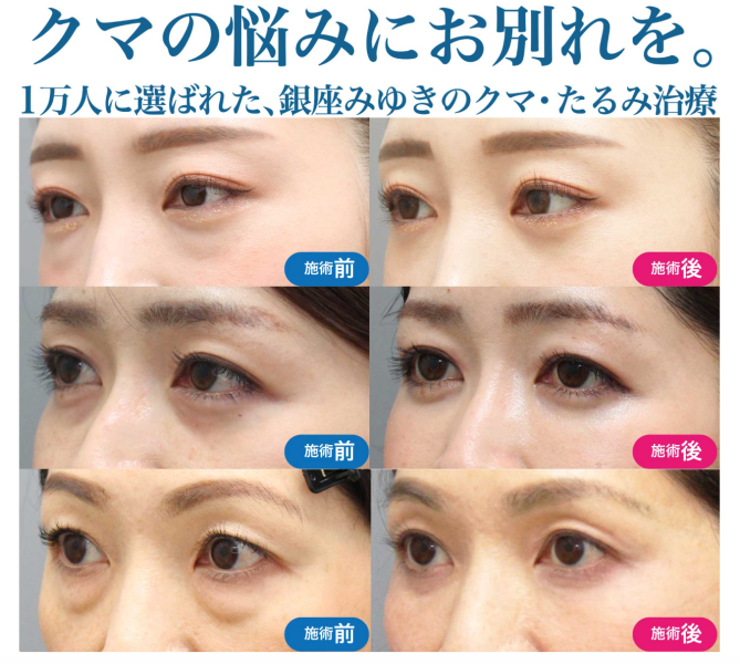 銀座みゆき通り美容外科クマたるみとり