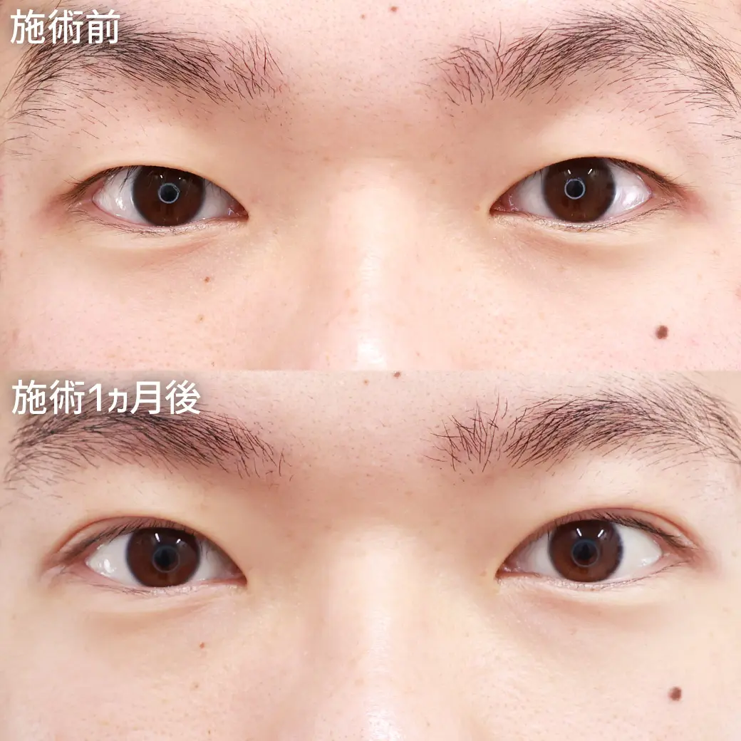 福田先生　二重整形　症例
