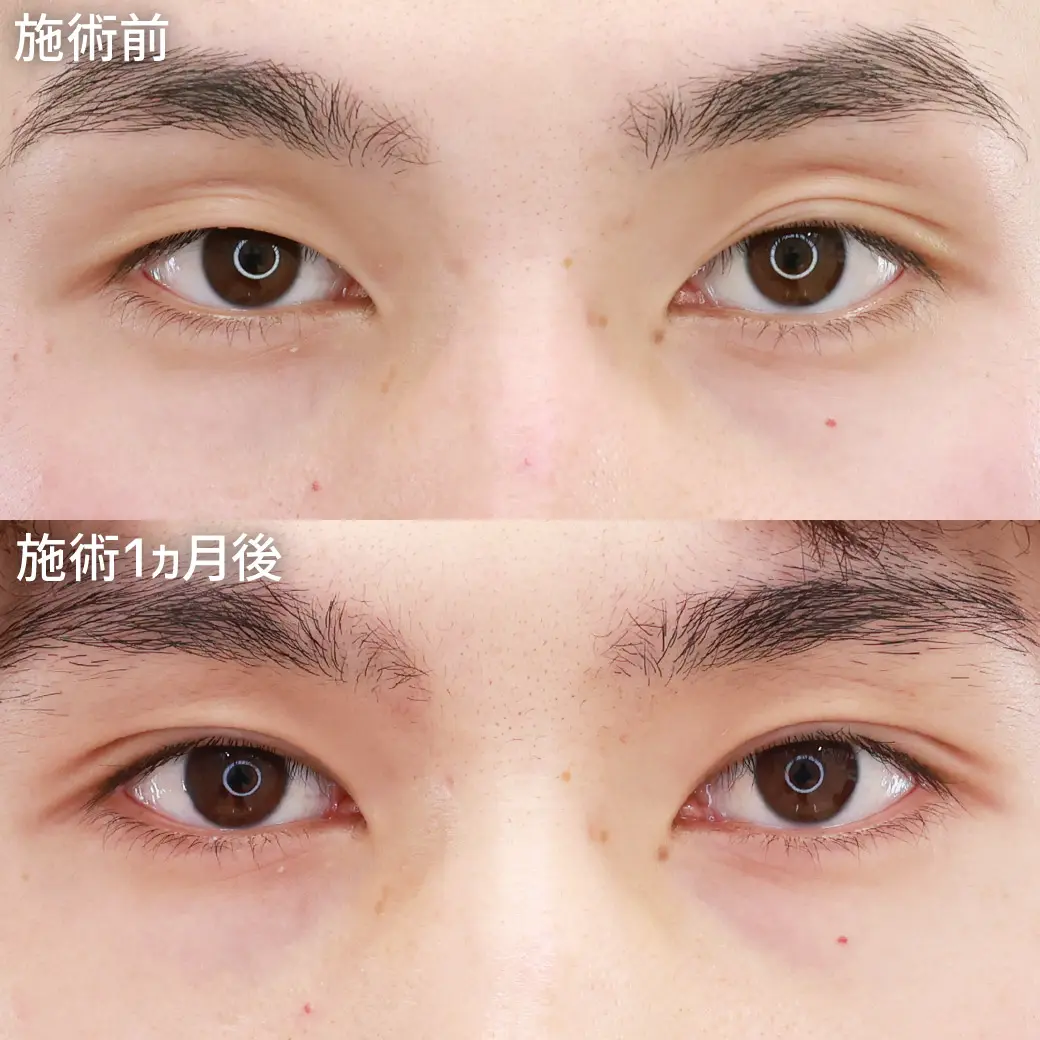 平松先生　二重整形　症例