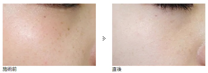 共立美容外科のシミ取りで、シミが跡形もなくキレイに