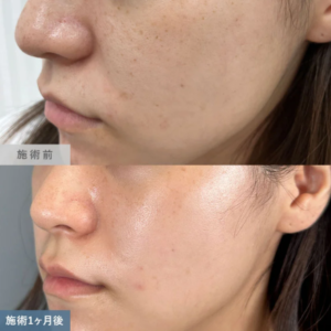 TCBのシミ取り症例写真