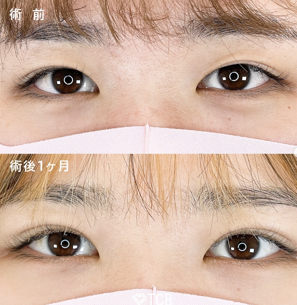 TCB二重整形症例