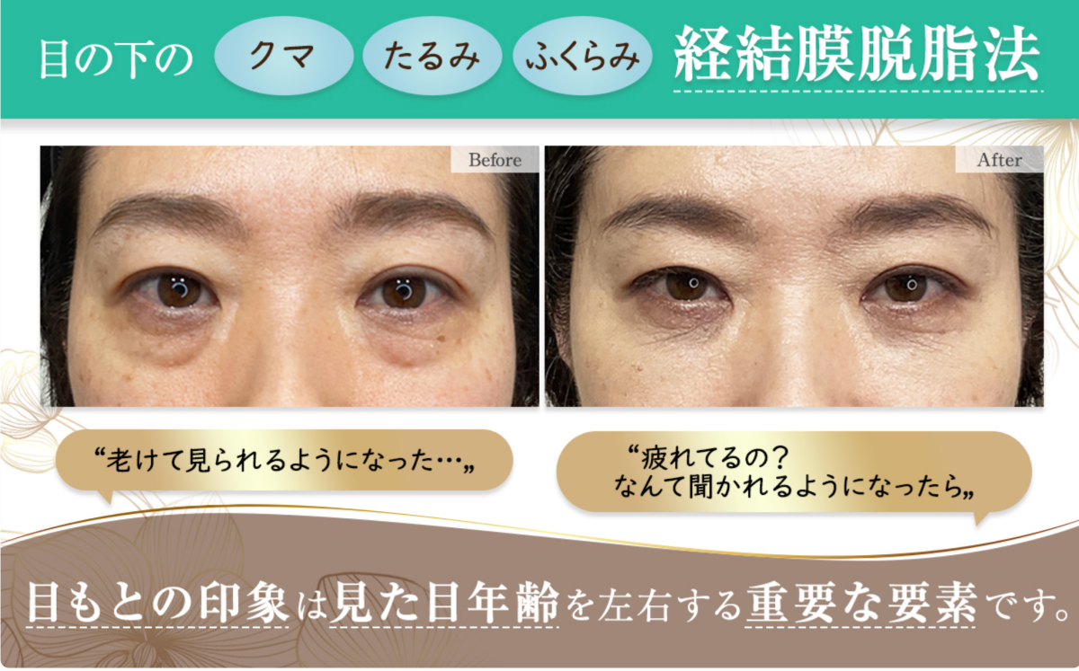 シンシアガーデンクリニック  クマ取り