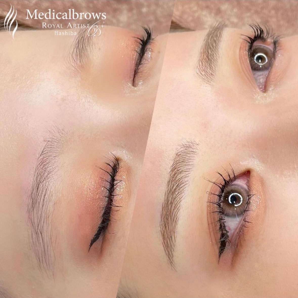 メディカルブロー羽柴さん症例写真