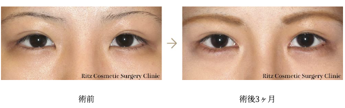 リッツ美容外科　目頭切開