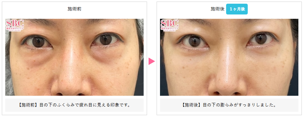 湘南美容クリニックの切らないクマ取り＋脂肪注入の症例写真