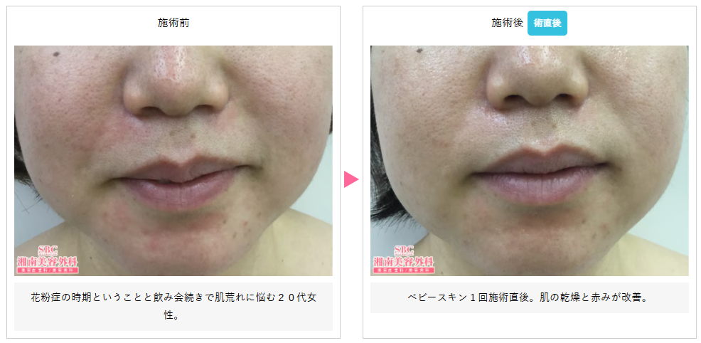 湘南美容クリニックのベビースキン＋エレクトロポレーションの症例写真