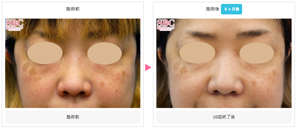 湘南美容クリニックのベビースキン＋ピコトーニング症例写真