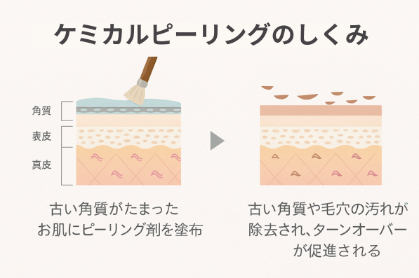 ケミカルピーリングのしくみ