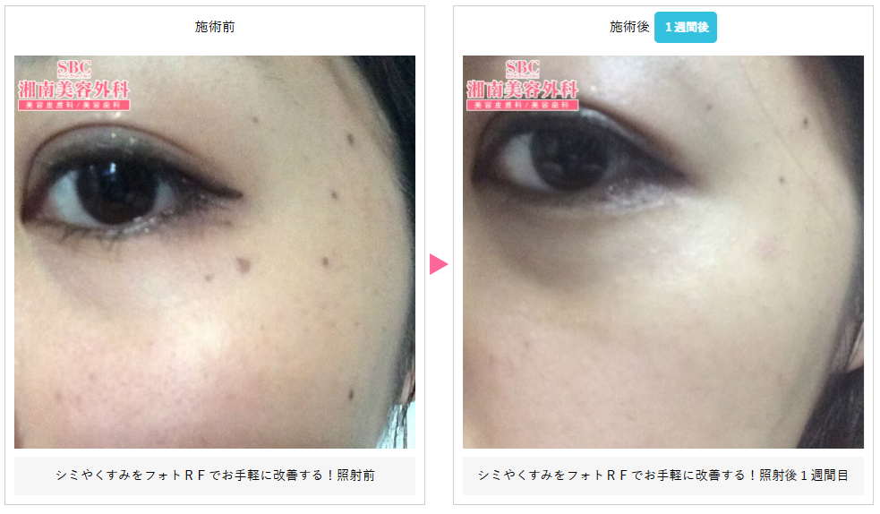 湘南美容クリニックのフォトRFの症例写真