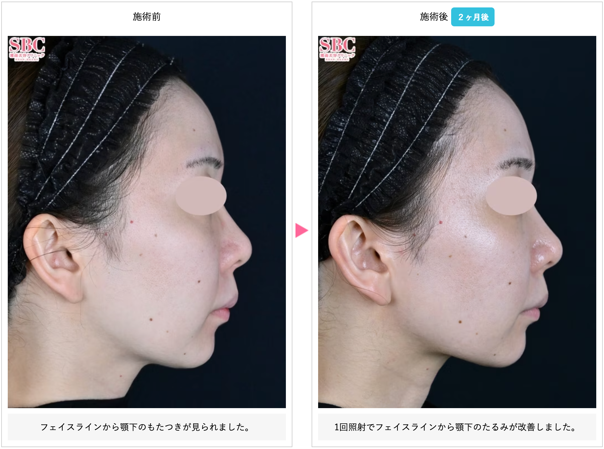 湘南美容クリニック ウルセラ 症例