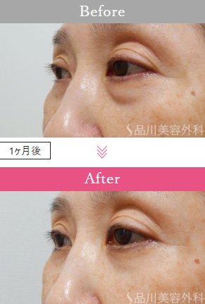 品川美容外科の切らないクマ取り症例写真