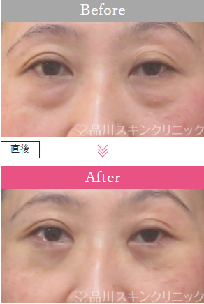 品川美容外科の切らないクマ取り症例写真