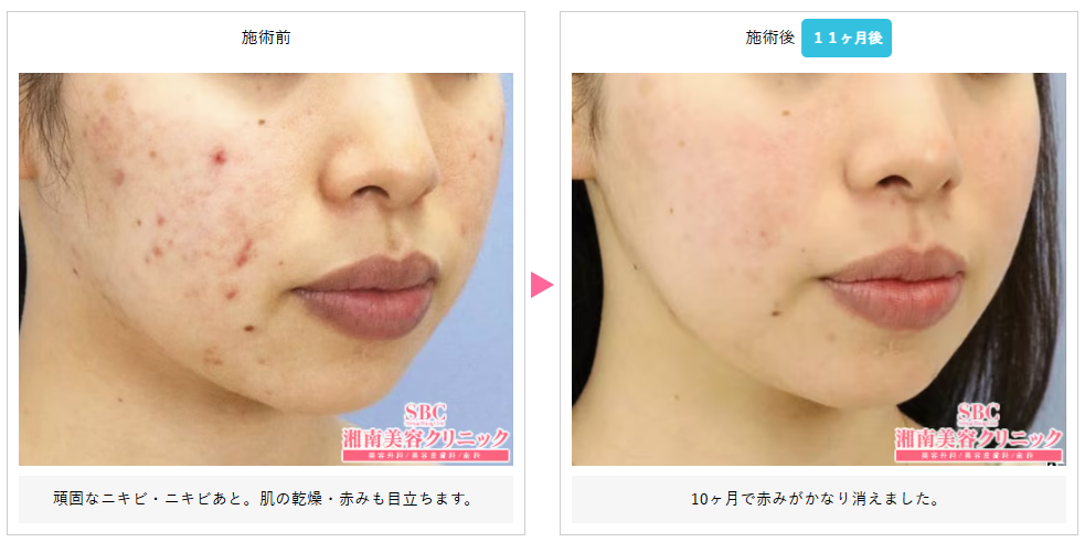 湘南美容クリニックのケミカルピーリング症例写真