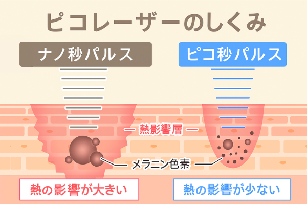 ピコレーザーのしくみ