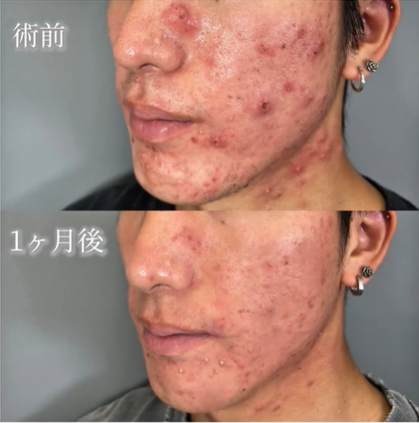TCBのハイドラフェイシャル症例写真