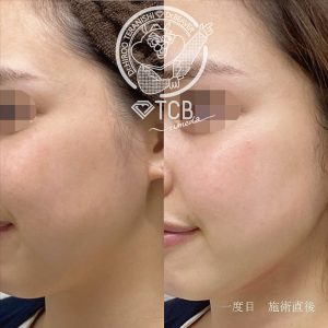 TCB ハイフ 症例