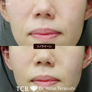TCB ハイフ 症例