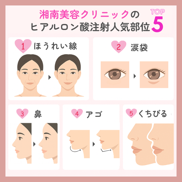 湘南美容クリニックのヒアルロン酸注射人気部位TOP5と施術で得られる効果