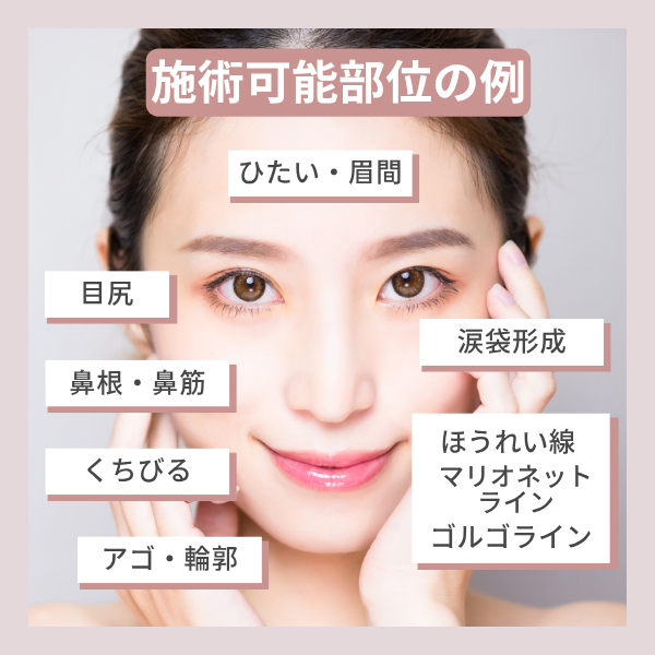 品川美容外科のヒアルロン酸注射注入可能部位