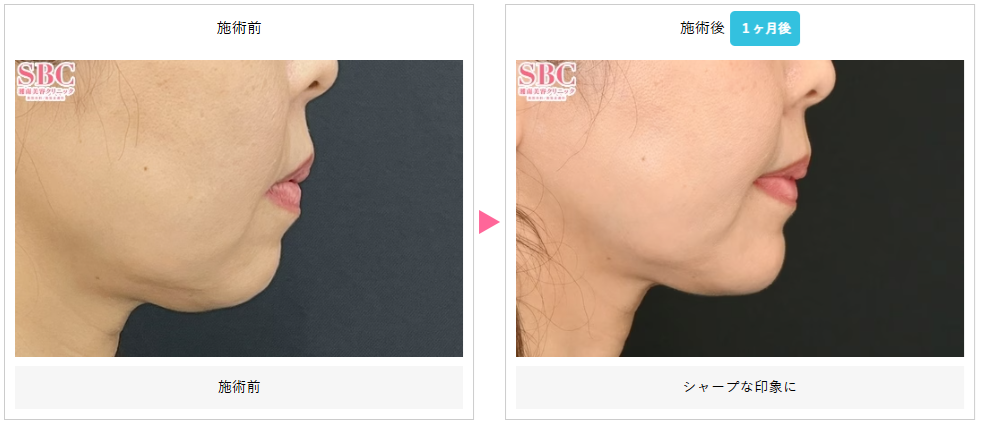 湘南美容クリニックのヒアルロン酸アゴ形成症例写真