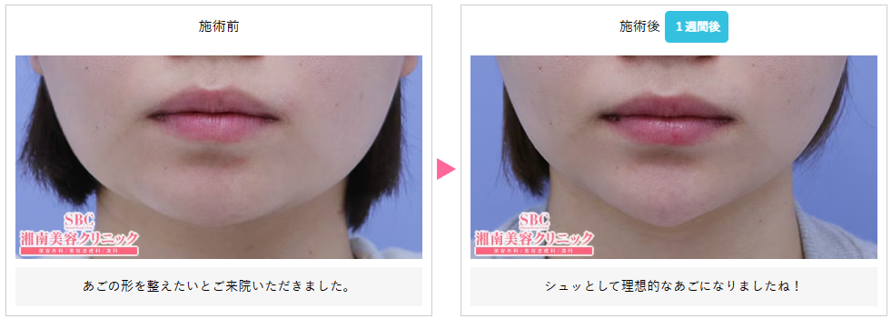 湘南美容クリニックのヒアルロン酸アゴ形成症例写真
