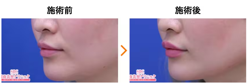 湘南美容クリニックのヒアルロン酸くちびる整形症例写真
