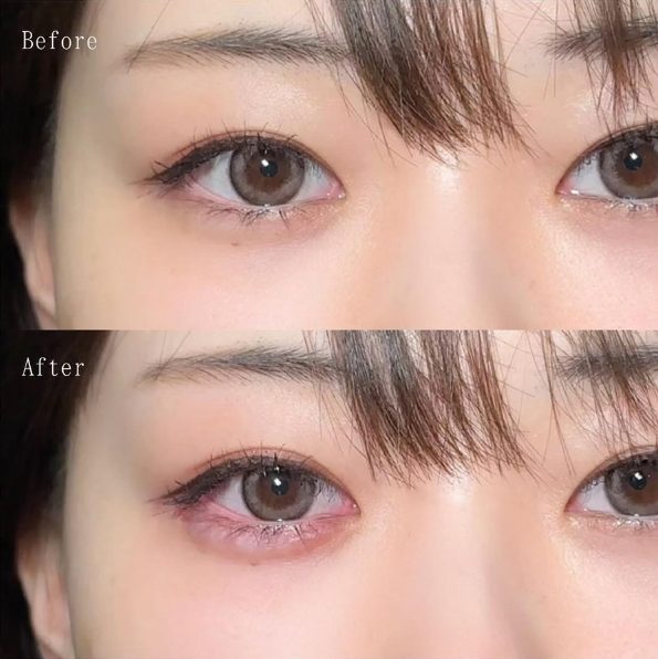 TCBのヒアルロン酸注射涙袋形成症例写真