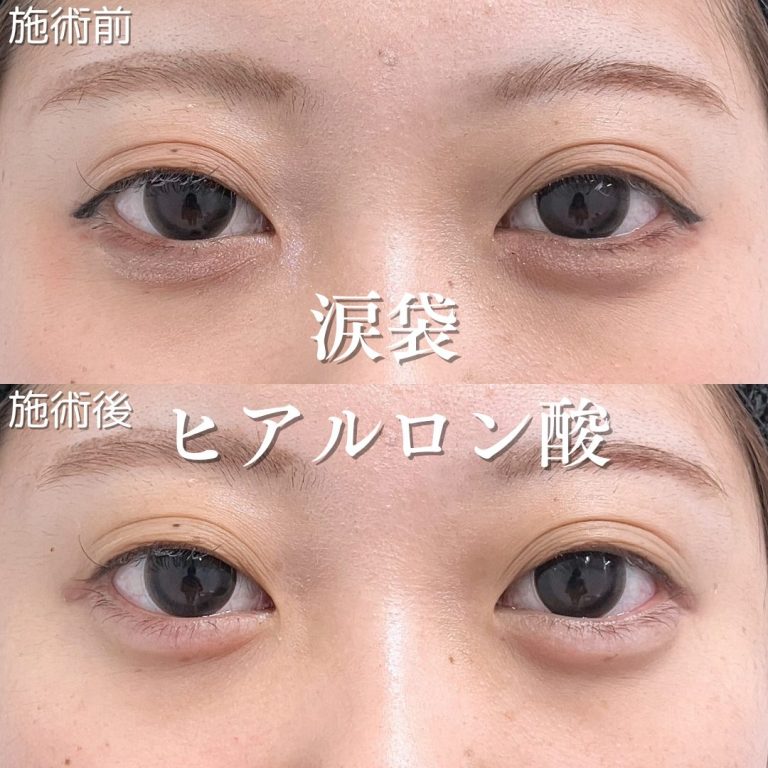 TCBのヒアルロン酸注射涙袋形成症例写真
