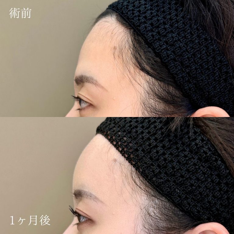 TCBのヒアルロン酸注射おでこ症例写真