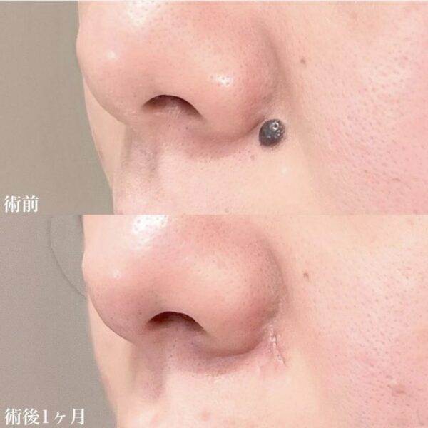 TCBのほくろ除去症例写真（鼻わき）