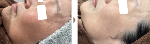 Jasmine Skin Clinic症例写真