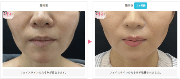 湘南美容クリニックのボトックスリフトの症例写真
