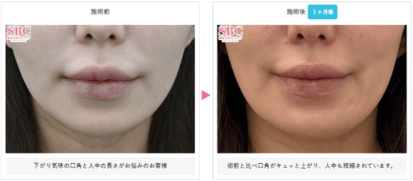 湘南美容クリニックの人中短縮&口角ボトックスの症例