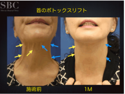 湘南美容クリニックの頸部ボトックスの症例写真