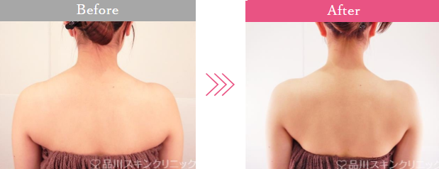 品川美容外科の肩ボトックス症例写真