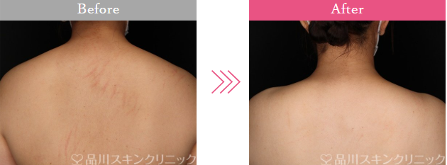 品川美容外科の肩ボトックス症例写真