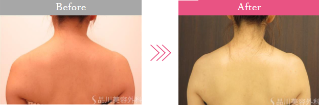 品川美容外科の肩ボトックス症例写真