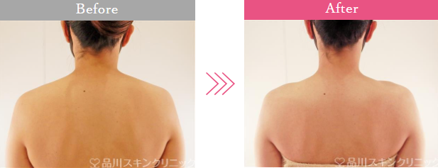 品川美容外科の肩ボトックス症例写真